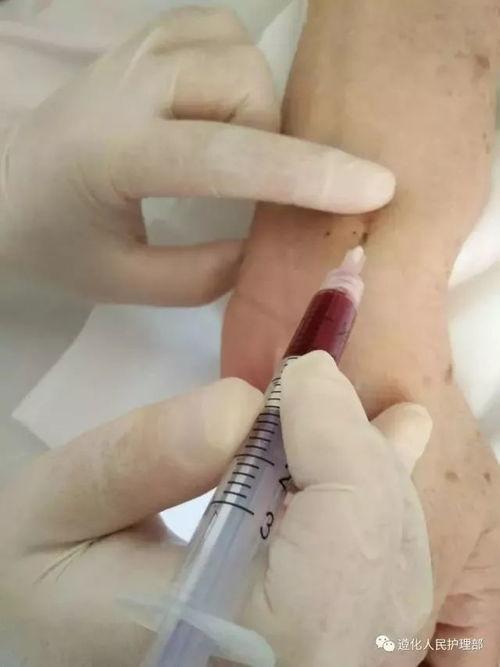成人桡动脉采血方法视频,成人桡动脉采血操作步骤详解
